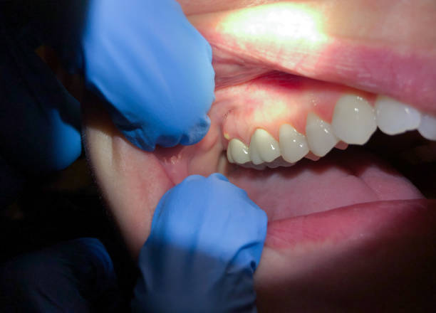 Best Emergency Treatment for Toothache in Chula Vista, TX